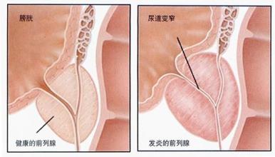 河池前列腺结石的症状是什么